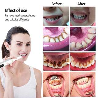 Ultrasonic Scaler Dental Calculus Remover Teeth Tartar Eliminator Sonic Plaque Cleaner Electric Tooth Stain Stone Removal Device